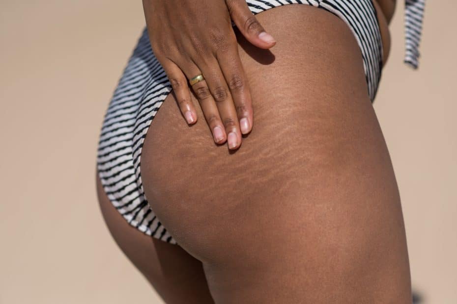 Stretch Marks