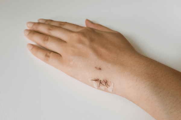 A Guide On How To Suture A Wound