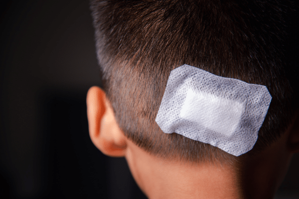 A Guide On How To Suture A Wound